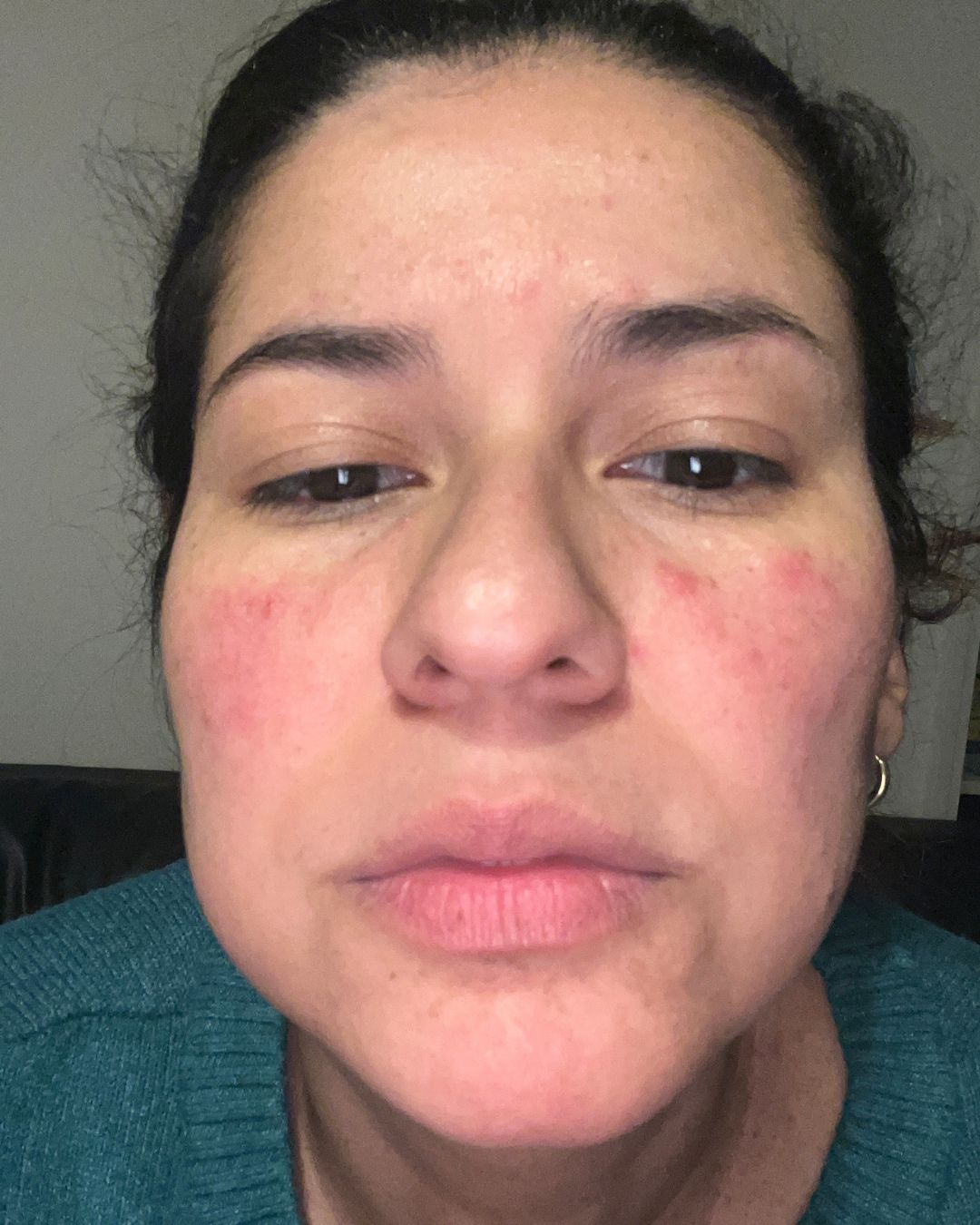 Karla voor gebruik GlowBiotica — droge huid en uitslag